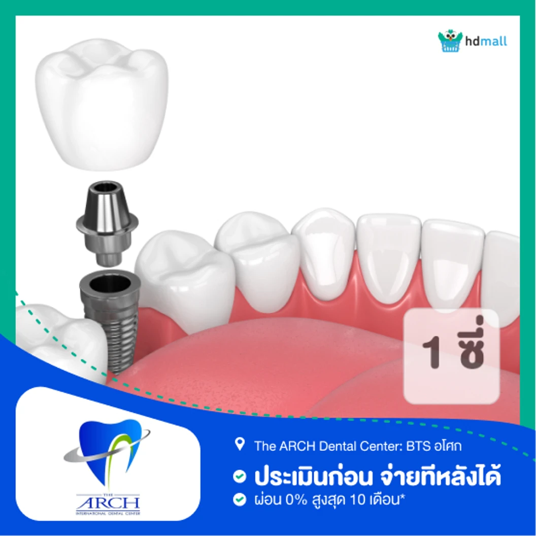 ทำรากฟันเทียม ยี่ห้อ Osstem รวมครอบฟัน 1 ซี่ ที่ The ARCH Dental Center ศูนย์ทันตกรรมดิอาร์ช