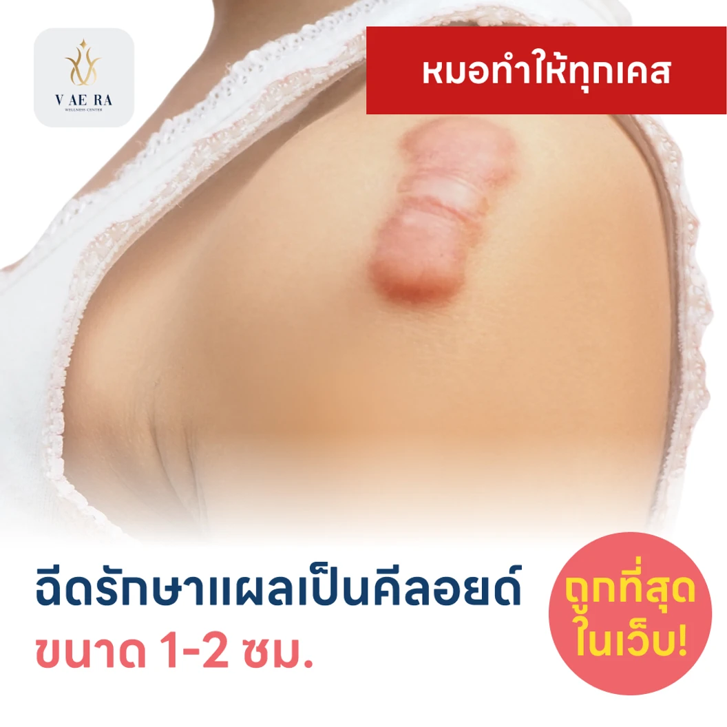 ฉีดรักษาแผลเป็นคีลอยด์ ขนาดเส้นผ่านศูนย์กลาง 1-2 ซม. 1 จุด 1 ครั้ง แพ็กเกจ HDmall+ ที่ V AE RA WELLNESS CENTER