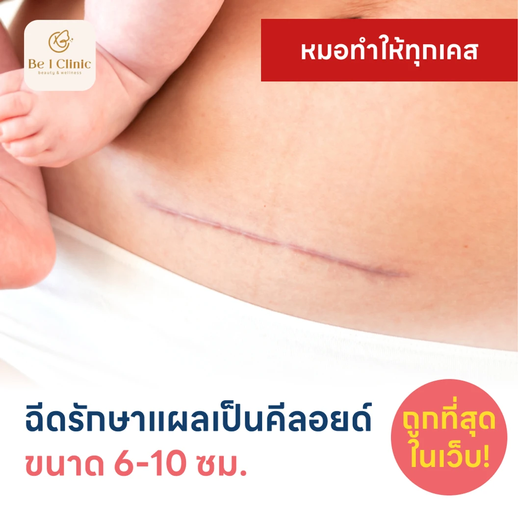 ฉีดรักษาแผลเป็นคีลอยด์ ขนาดเส้นผ่านศูนย์กลาง 6-10 ซม 1 จุด 1 ครั้ง แพ็กเกจ HDmall+ ที่ Be1Clinic