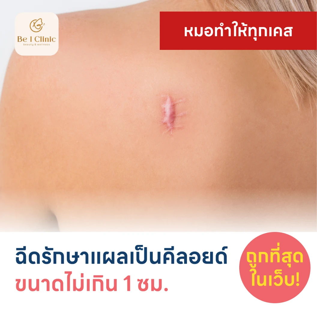 ฉีดรักษาแผลเป็นคีลอยด์ ขนาดเส้นผ่านศูนย์กลางไม่เกิน 1 ซม 1 จุด 1 ครั้ง แพ็กเกจ HDmall+ ที่ Be1Clinic