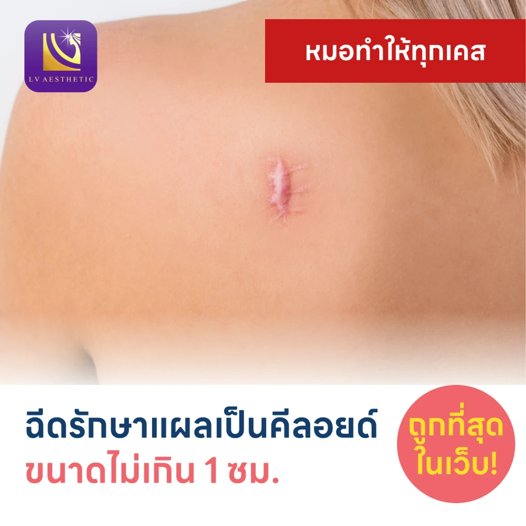 ฉีดรักษาแผลเป็นคีลอยด์ ขนาดเส้นผ่านศูนย์กลางไม่เกิน 1 ซม 1 จุด 1 ครั้ง แพ็กเกจ HDmall+ ที่ LV Aesthetic Clinic แอลวีเอสเธติค รัชดา 48