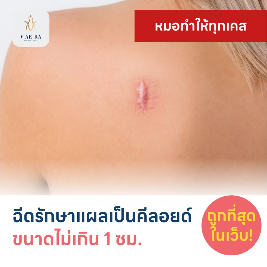 ฉีดรักษาแผลเป็นคีลอยด์ ขนาดเส้นผ่านศูนย์กลางไม่เกิน 1 ซม. 1 จุด 1 ครั้ง แพ็กเกจ HDmall+ ที่ V AE RA WELLNESS CENTER