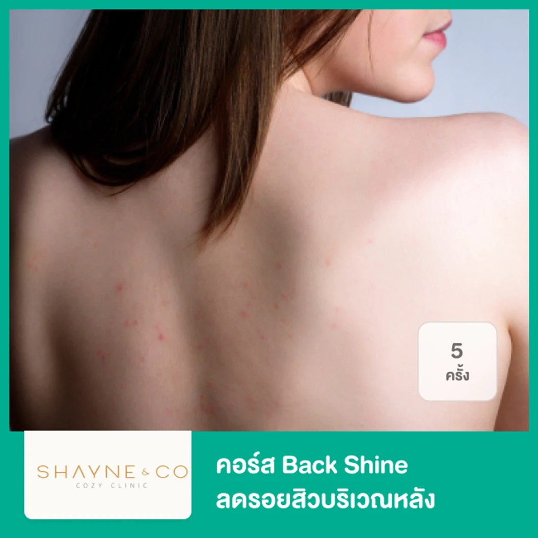 คอร์ส Back Shine ลดรอยสิวบริเวณหลัง 5 ครั้ง ที่ Shayne & Co. Clinic
