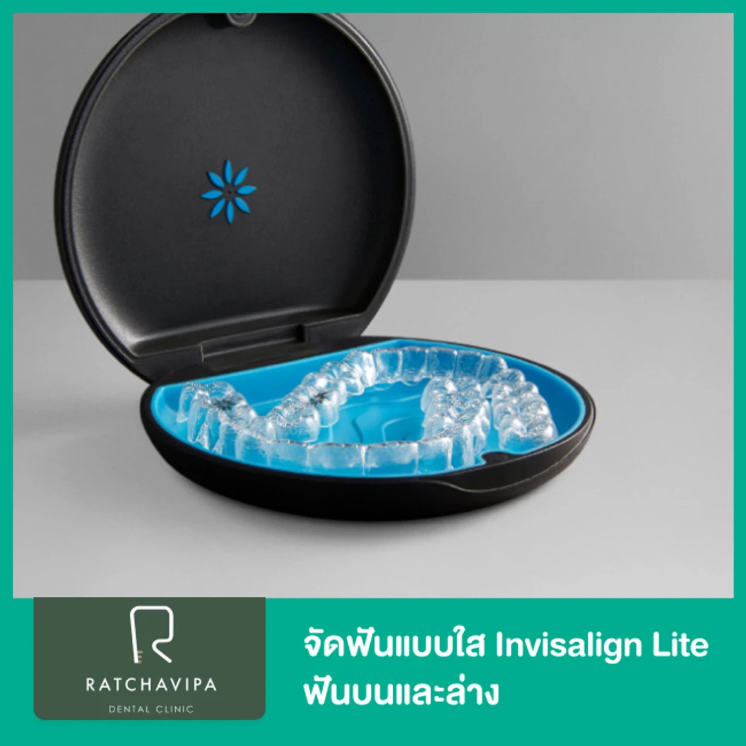 จัดฟันแบบใส Invisalign Lite ฟันบนและล่าง ที่ Ratchavipa Dental Clinic คลินิกทันตกรรมรัชวิภา