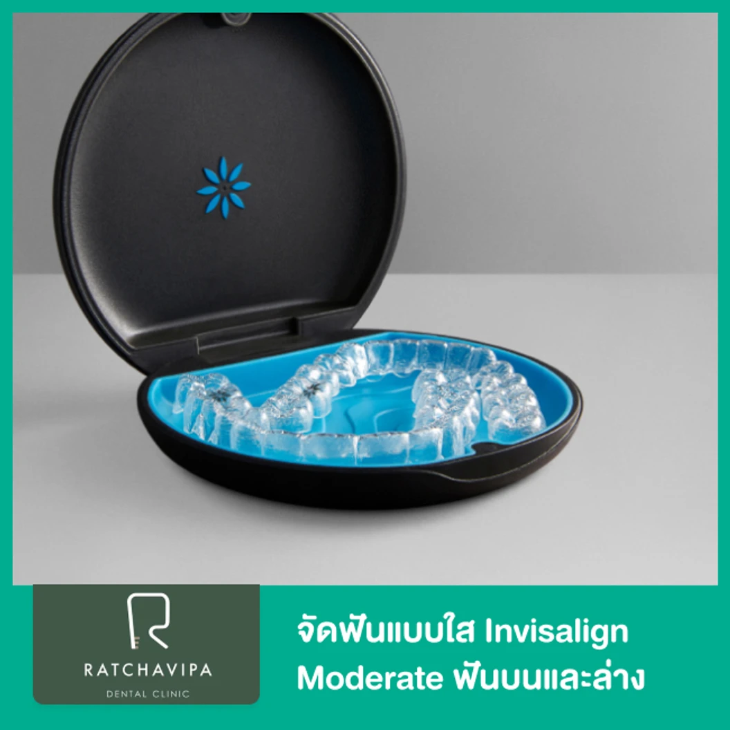 จัดฟันแบบใส Invisalign Moderate ฟันบนและล่าง ที่ Ratchavipa Dental Clinic คลินิกทันตกรรมรัชวิภา