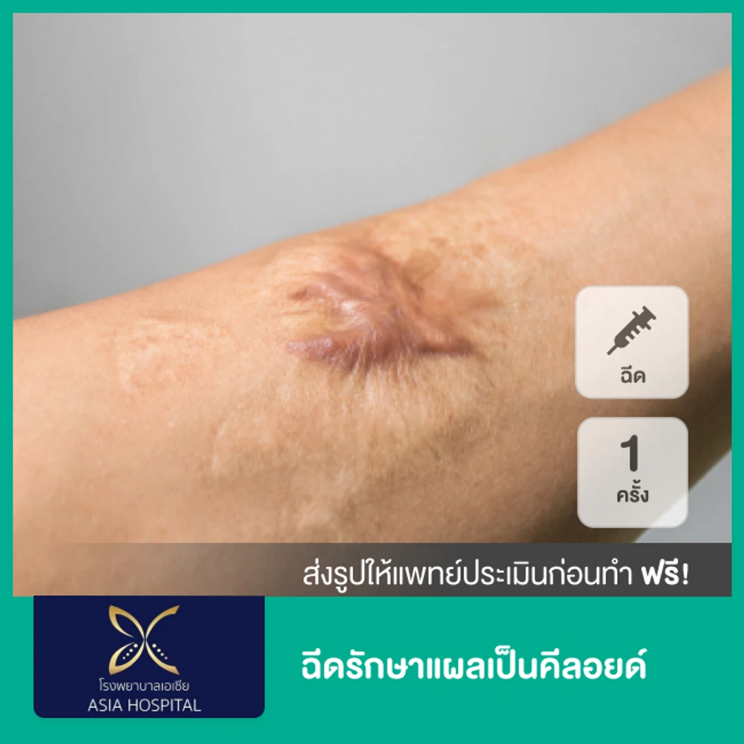 ฉีดรักษาแผลเป็นคีลอยด์ 1 ครั้ง ที่ โรงพยาบาลเอเซีย