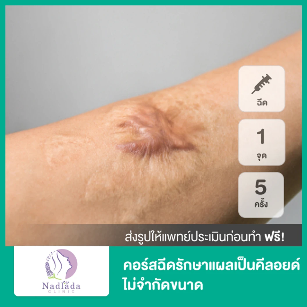 คอร์สฉีดรักษาแผลเป็นคีลอยด์ 1 จุด ไม่จำกัดขนาด 5 ครั้ง ที่ Nadlada Clinic
