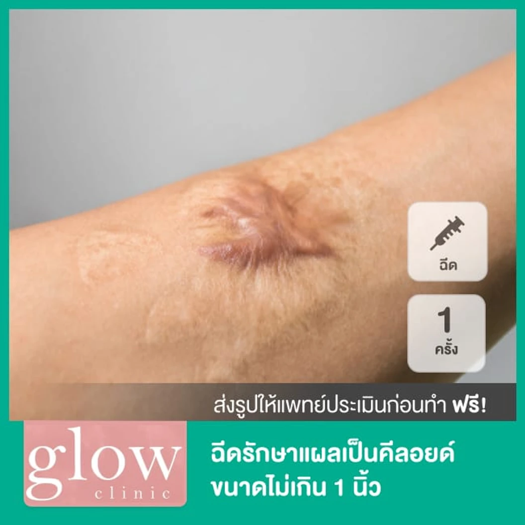 ฉีดรักษาแผลเป็นคีลอยด์ขนาดไม่เกิน 1 นิ้ว 1 ครั้ง ที่ Glow Clinic Thailand