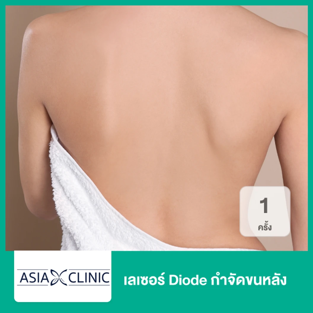 เลเซอร์ Diode กำจัดขนหลัง 1 ครั้ง ที่ Asia Clinic เอเซียคลินิก