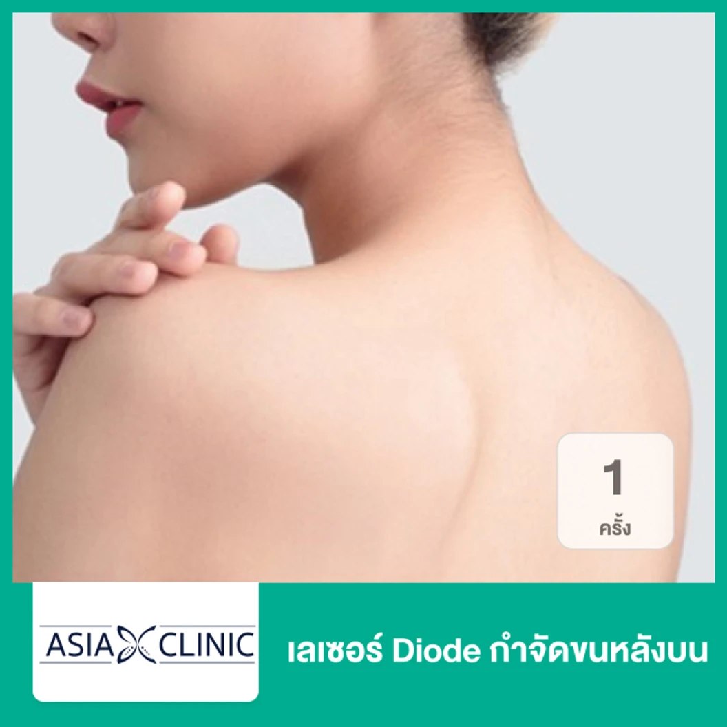 เลเซอร์ Diode กำจัดขนหลังบน 1 ครั้ง ที่ Asia Clinic เอเซียคลินิก