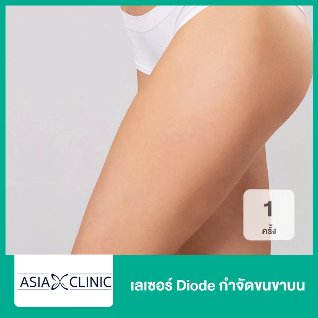 เลเซอร์ Diode กำจัดขนขาบน 1 ครั้ง ที่ Asia Clinic เอเซียคลินิก