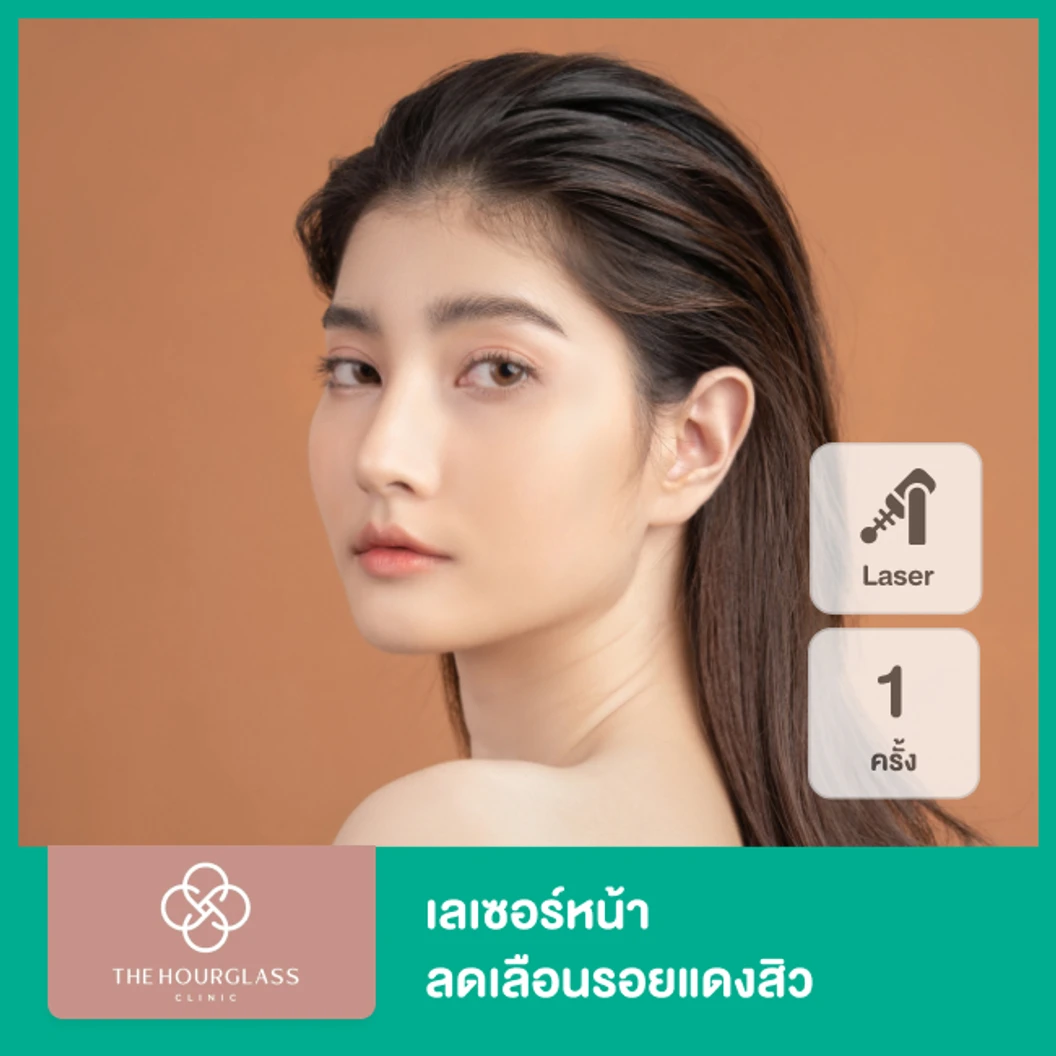 เลเซอร์หน้า เครื่อง Double White Laser OPT E ลดเลือนรอยแดงสิว 1 ครั้ง ที่ The Hourglass Clinic