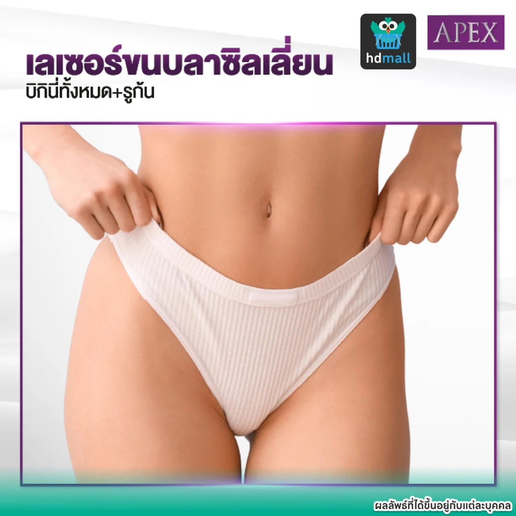 เลเซอร์ Dynamic Tech กำจัดขน Brazilian VO 1 ครั้ง ราคาทดลอง ที่ APEX Medical Center