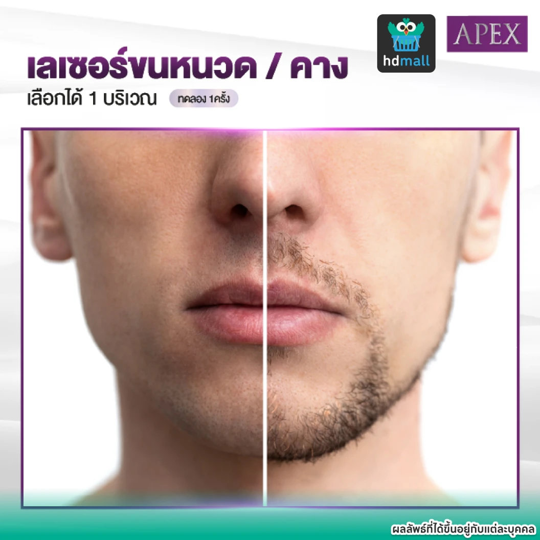 เลเซอร์ Dynamic Tech กำจัดขนหนวดหรือคาง 1 ครั้ง ราคาทดลอง ที่ APEX Medical Center