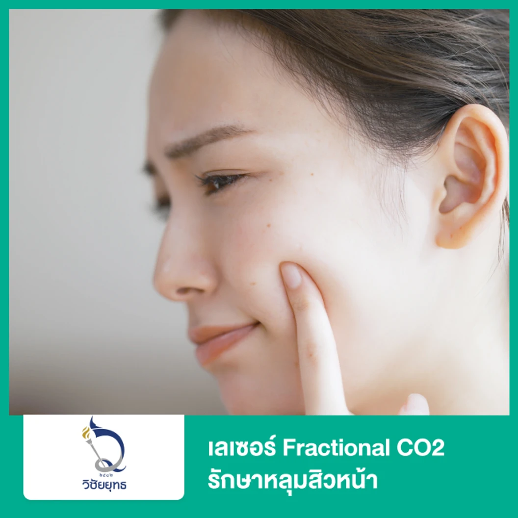เลเซอร์ Fractional CO2 รักษาหลุมสิวหน้า ที่ โรงพยาบาลวิชัยยุทธ
