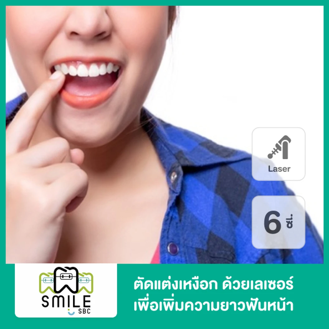 ตัดแต่งเหงือกด้วยเครื่อง Electrosurgery เพื่อเพิ่มความยาวฟันหน้า 6 ซี่ ที่ SmileSBC