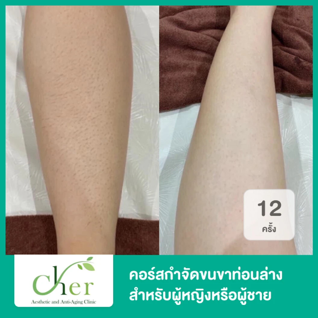 คอร์สกำจัดขนขาท่อนล่าง ด้วย Diode Laser 12 ครั้ง ภายใน 1 ปี สำหรับผู้หญิงหรือผู้ชาย ที่ Cher Clinic