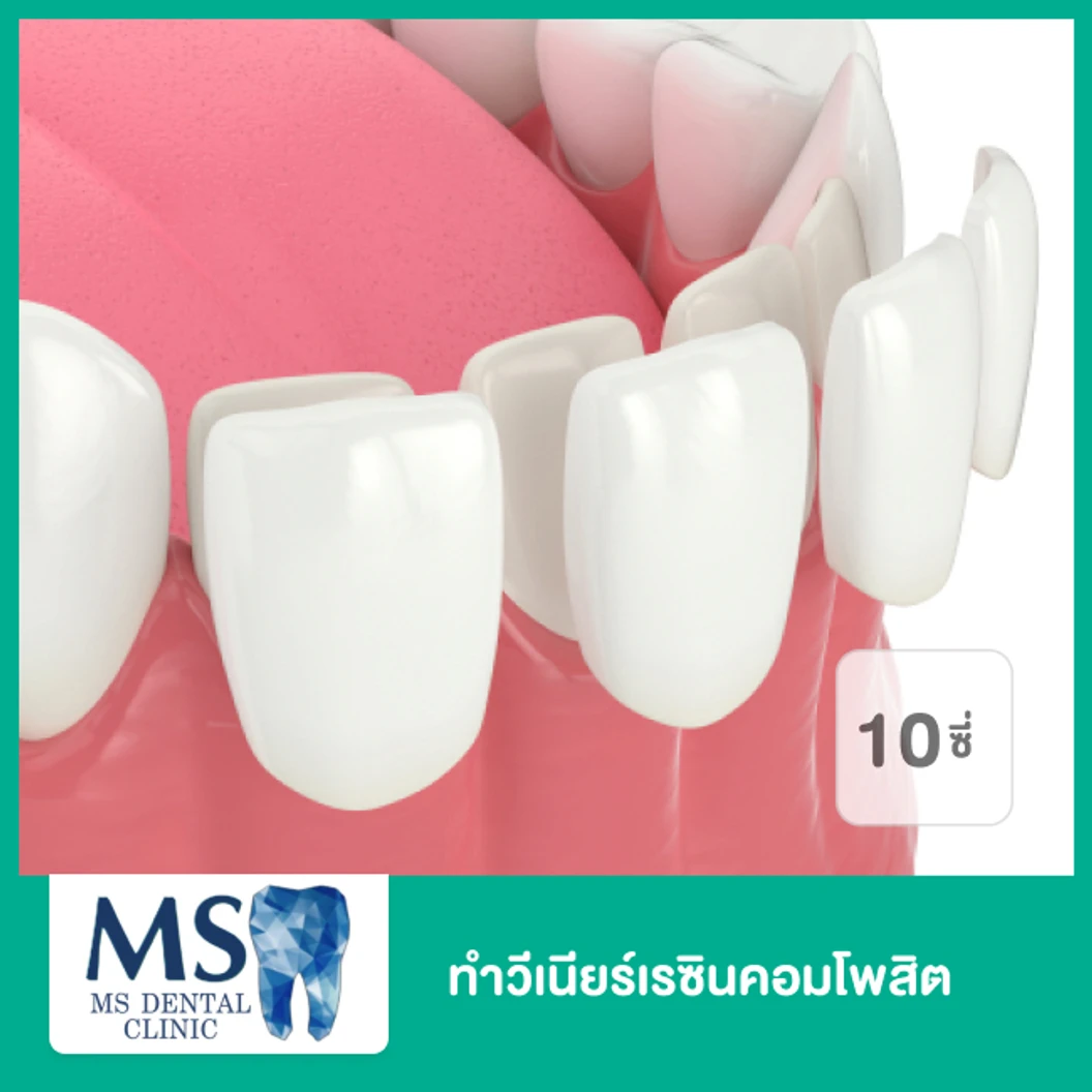 ทำวีเนียร์เรซินคอมโพสิต สำหรับฟัน 10 ซี่ ที่ MS Dental Clinic เอ็มเอสคลินิกทันตกรรม สุขุมวิท 39