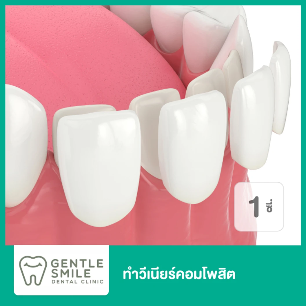 ทำวีเนียร์คอมโพสิต สำหรับฟัน 1 ซี่ ที่ Gentle Smile Dental Clinic