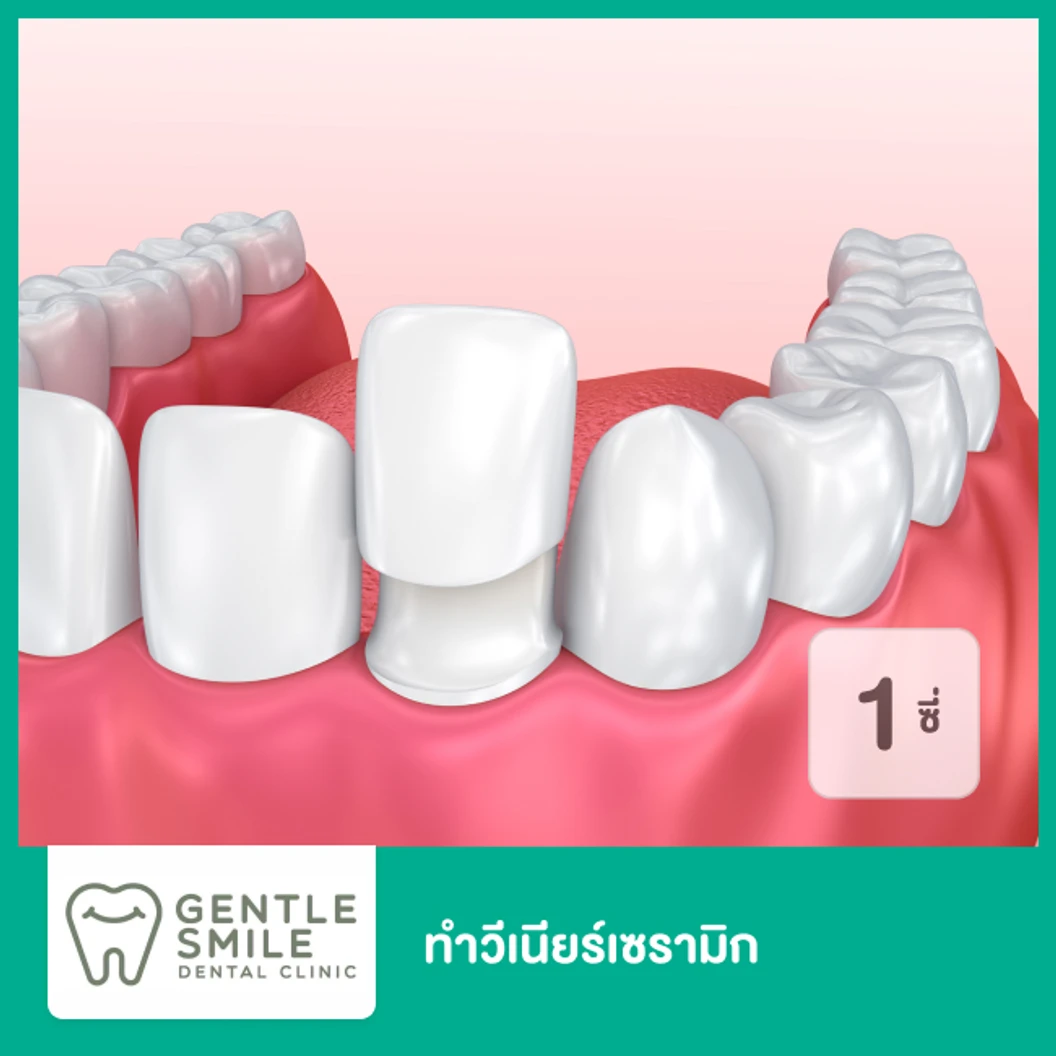 ทำวีเนียร์เซรามิก สำหรับฟัน 1 ซี่ ที่ Gentle Smile Dental Clinic