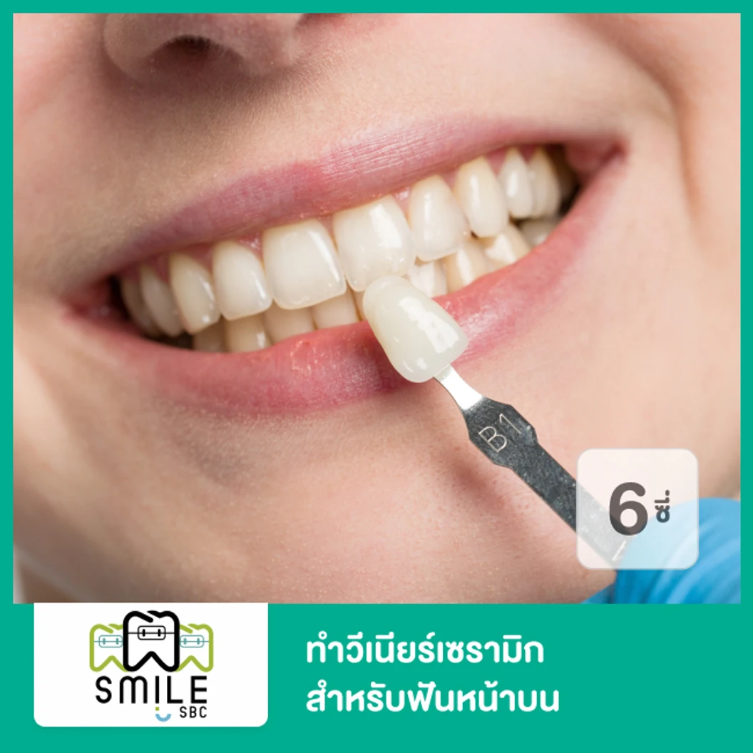 ทำวีเนียร์เซรามิก สำหรับฟันหน้าบน 6 ซี่ ที่ SmileSBC
