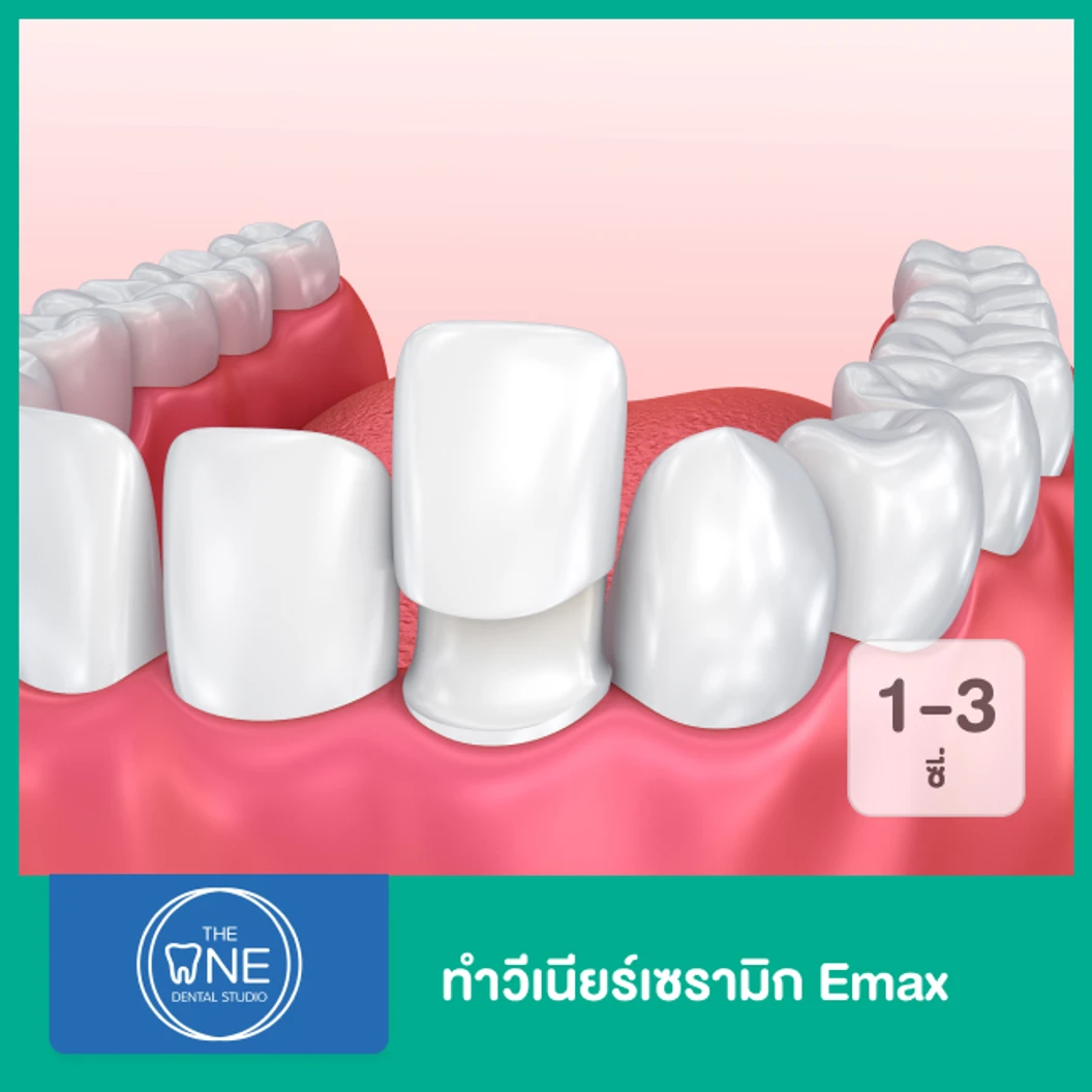 ทำวีเนียร์เซรามิก Emax 3 ซี่ ขึ้นไป ราคาต่อซี่ ที่ The One Dental Studio