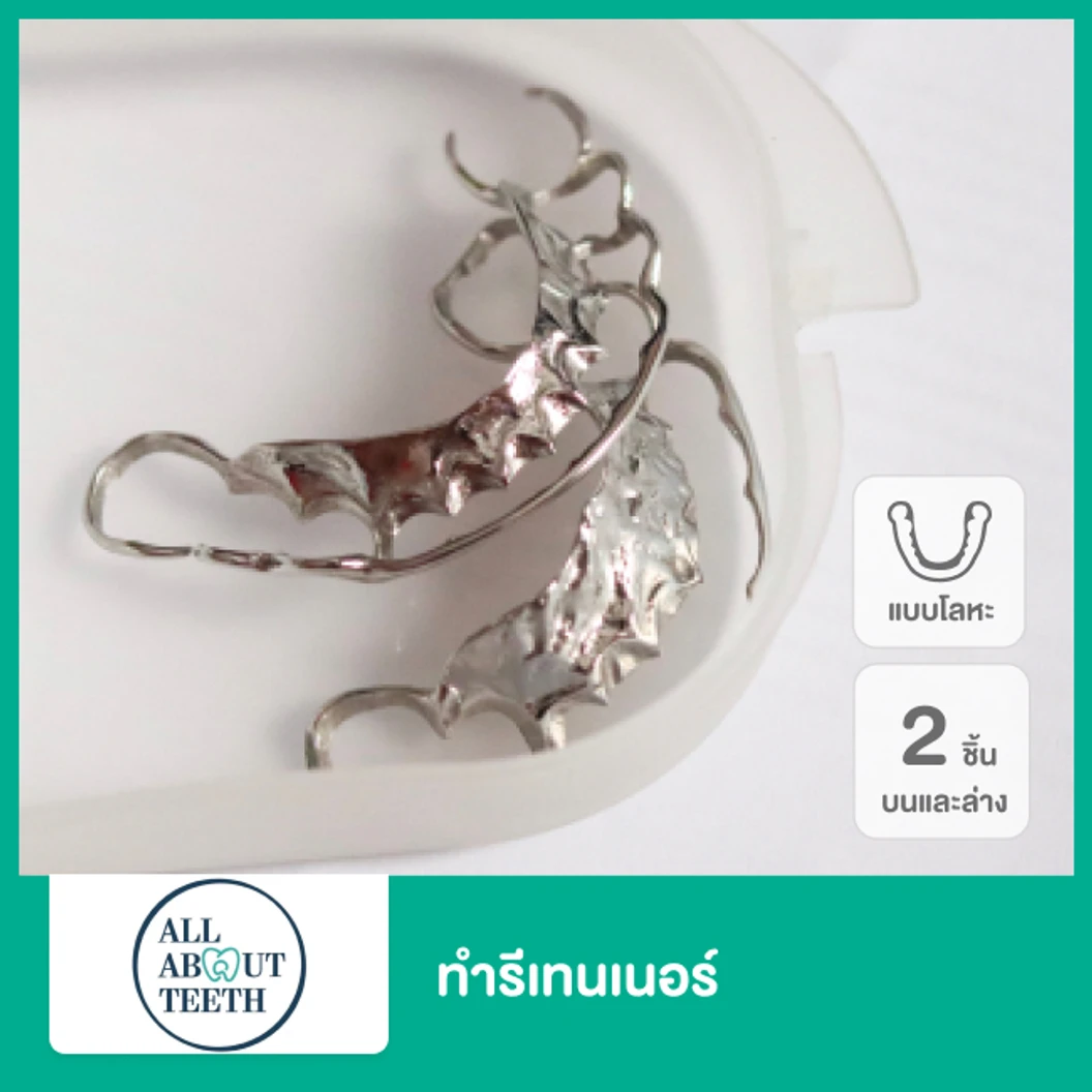 ทำรีเทนเนอร์แบบโลหะ 2 ชิ้น ฟันบนและล่าง ที่ All About Teeth Clinic