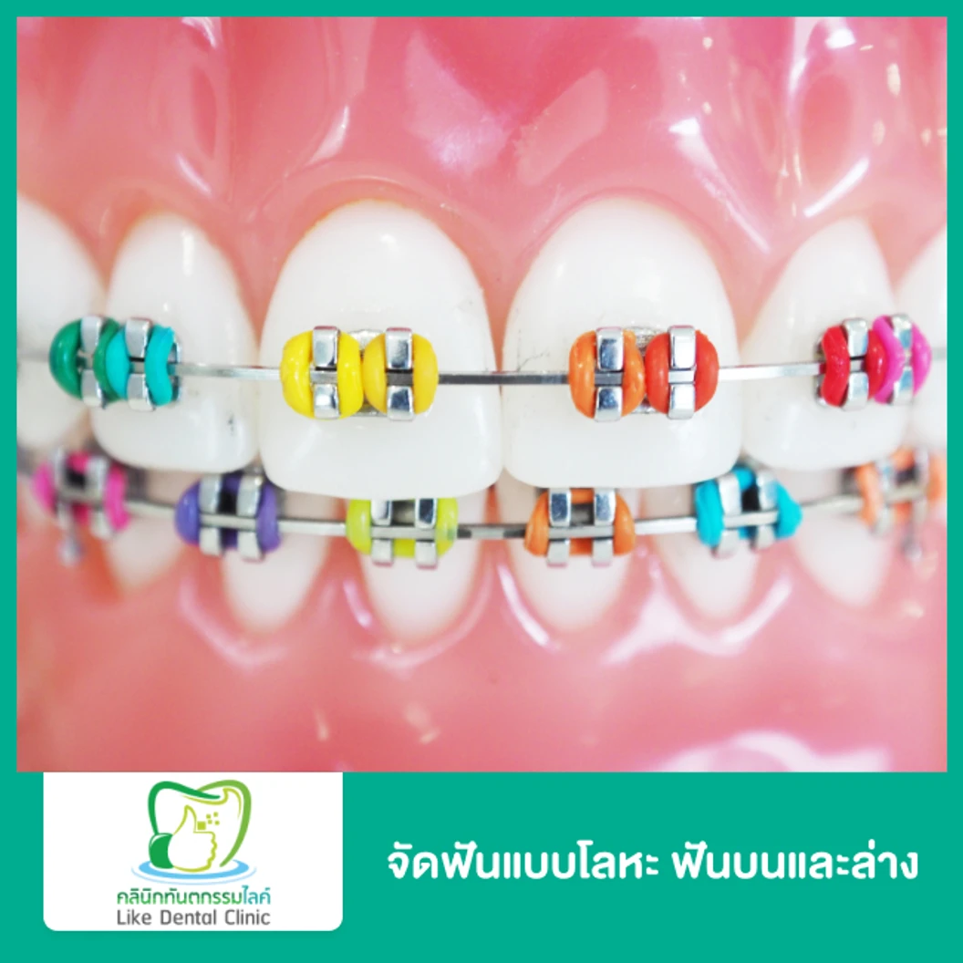 จัดฟันแบบโลหะ ฟันบนและล่าง ที่ Like Dental Clinic