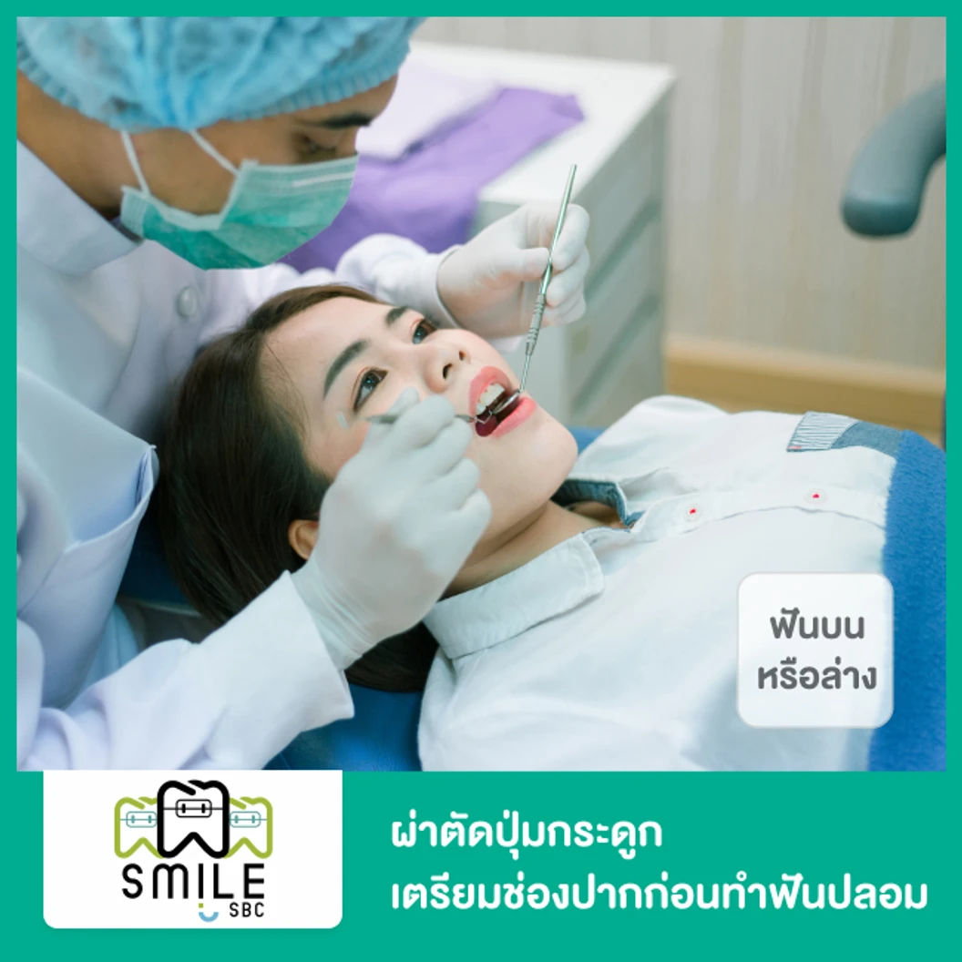ผ่าตัดปุ่มกระดูก เตรียมช่องปากก่อนทำฟันปลอม สำหรับฟันบนหรือล่าง ที่ SmileSBC