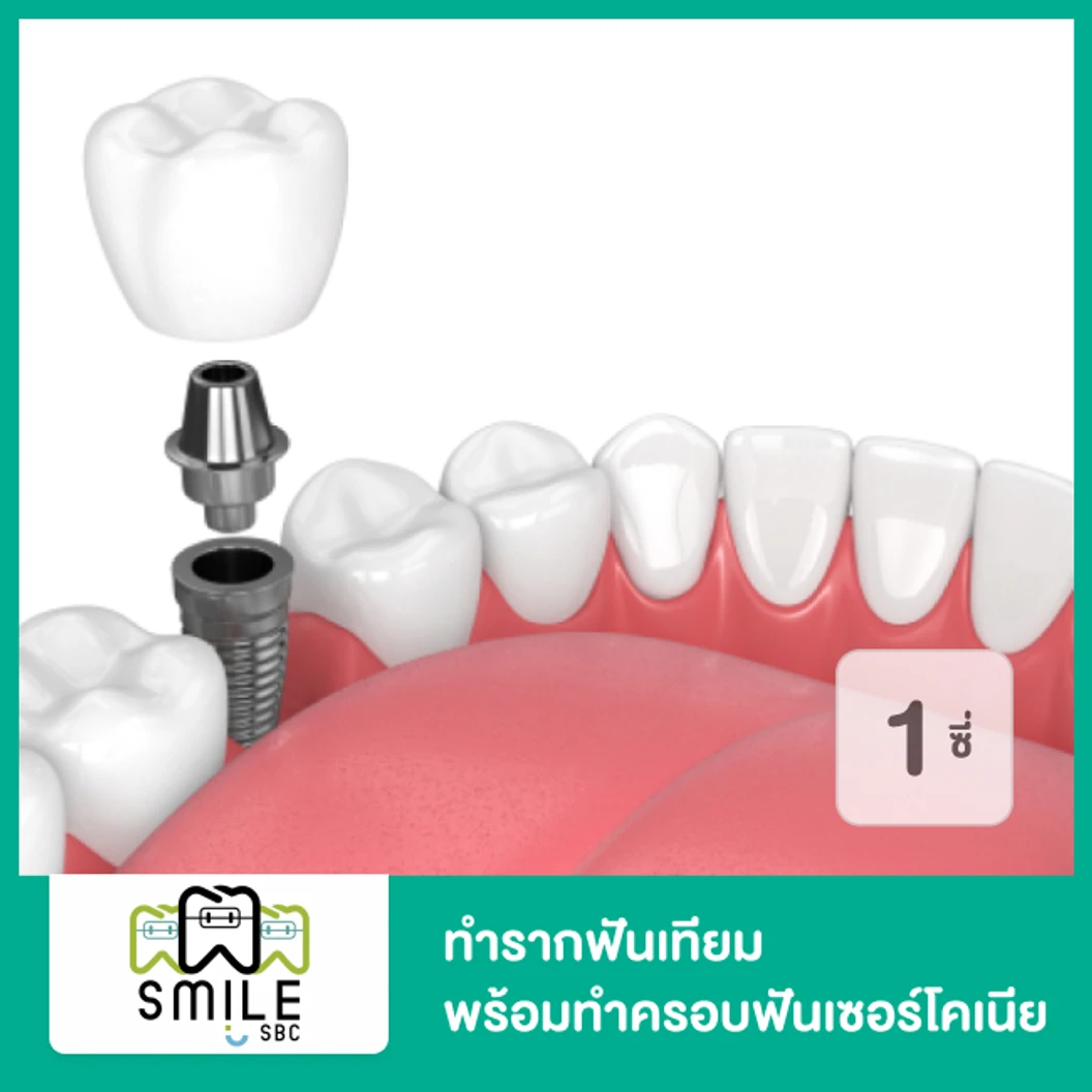 ทำรากฟันเทียม ยี่ห้อ Osstem พร้อมทำครอบฟันเซอร์โคเนีย สำหรับฟัน 1 ซี่ ที่ SmileSBC