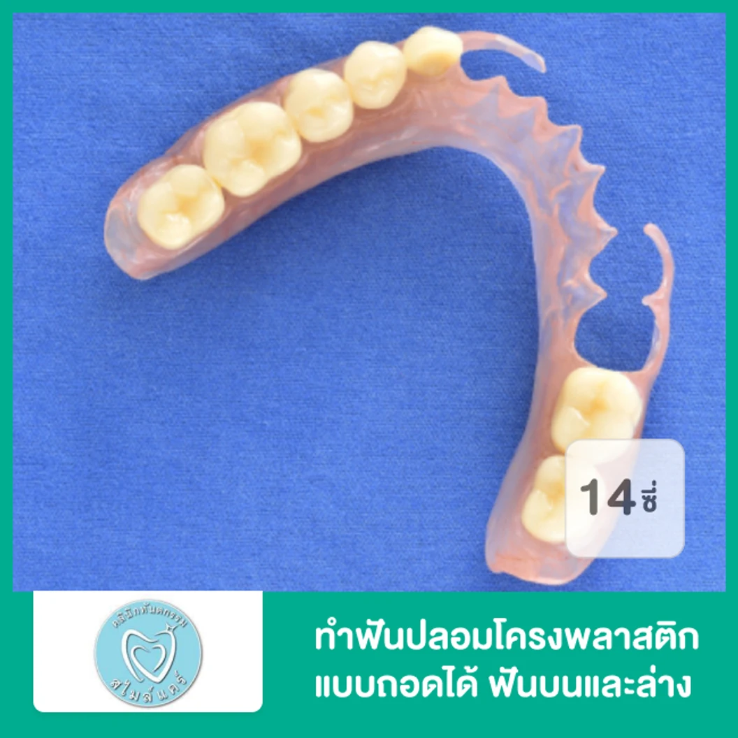 ทำฟันปลอมโครงพลาสติก แบบถอดได้ ฟันบนและล่างอย่างละ 14 ซี่ ที่ คลินิกทันตกรรมสไมล์แคร์ สมุทรปราการ