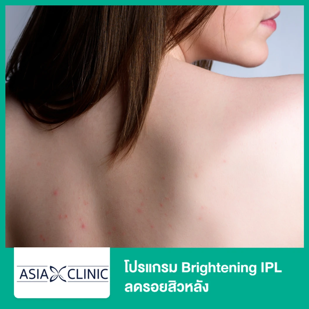 โปรแกรม Brightening IPL ลดรอยสิวหลัง ที่ Asia Clinic เอเซียคลินิก