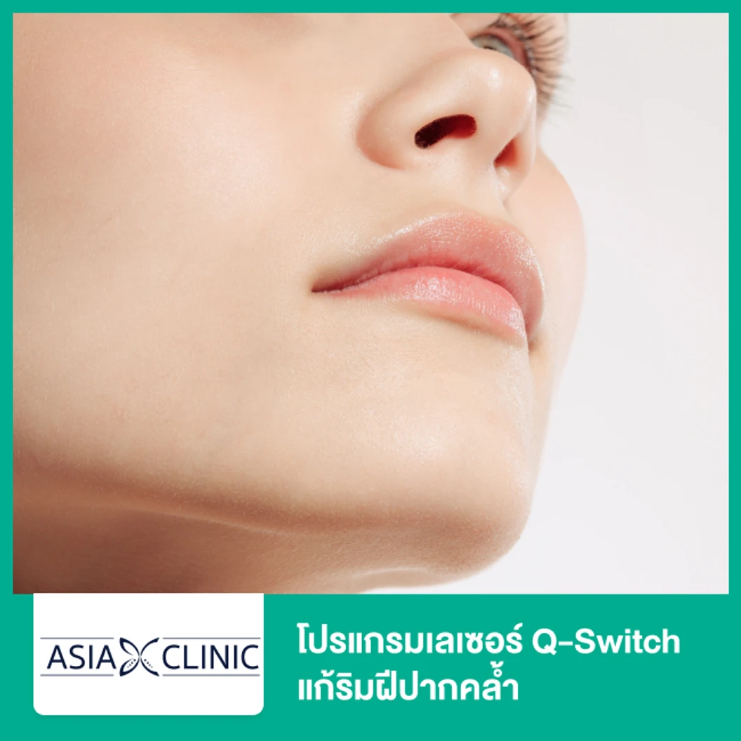 โปรแกรมเลเซอร์ Q-Switch แก้ริมฝีปากคล้ำ ที่ Asia Clinic เอเซียคลินิก