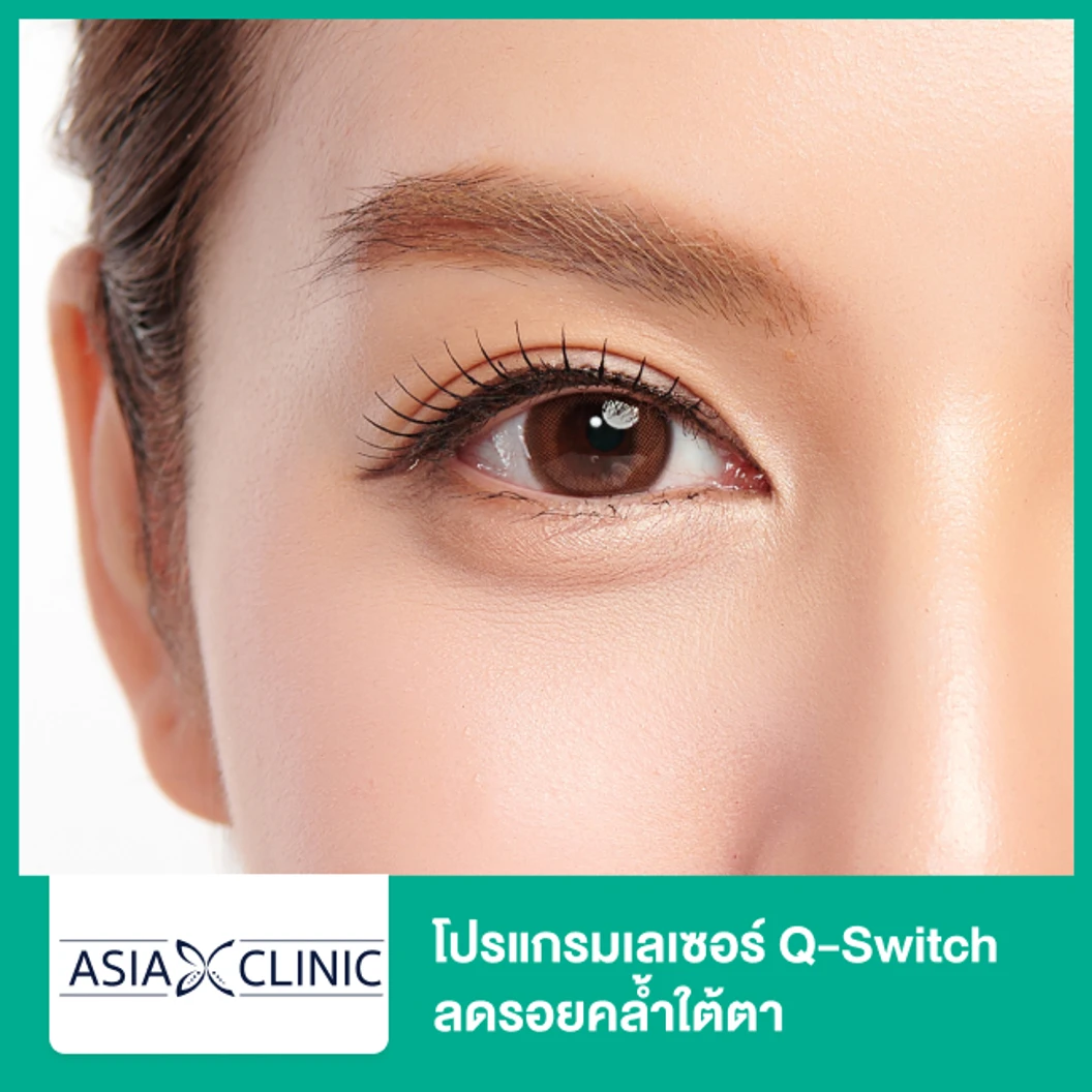 โปรแกรมเลเซอร์ Q-Switch ลดรอยคล้ำใต้ตา ที่ Asia Clinic เอเซียคลินิก