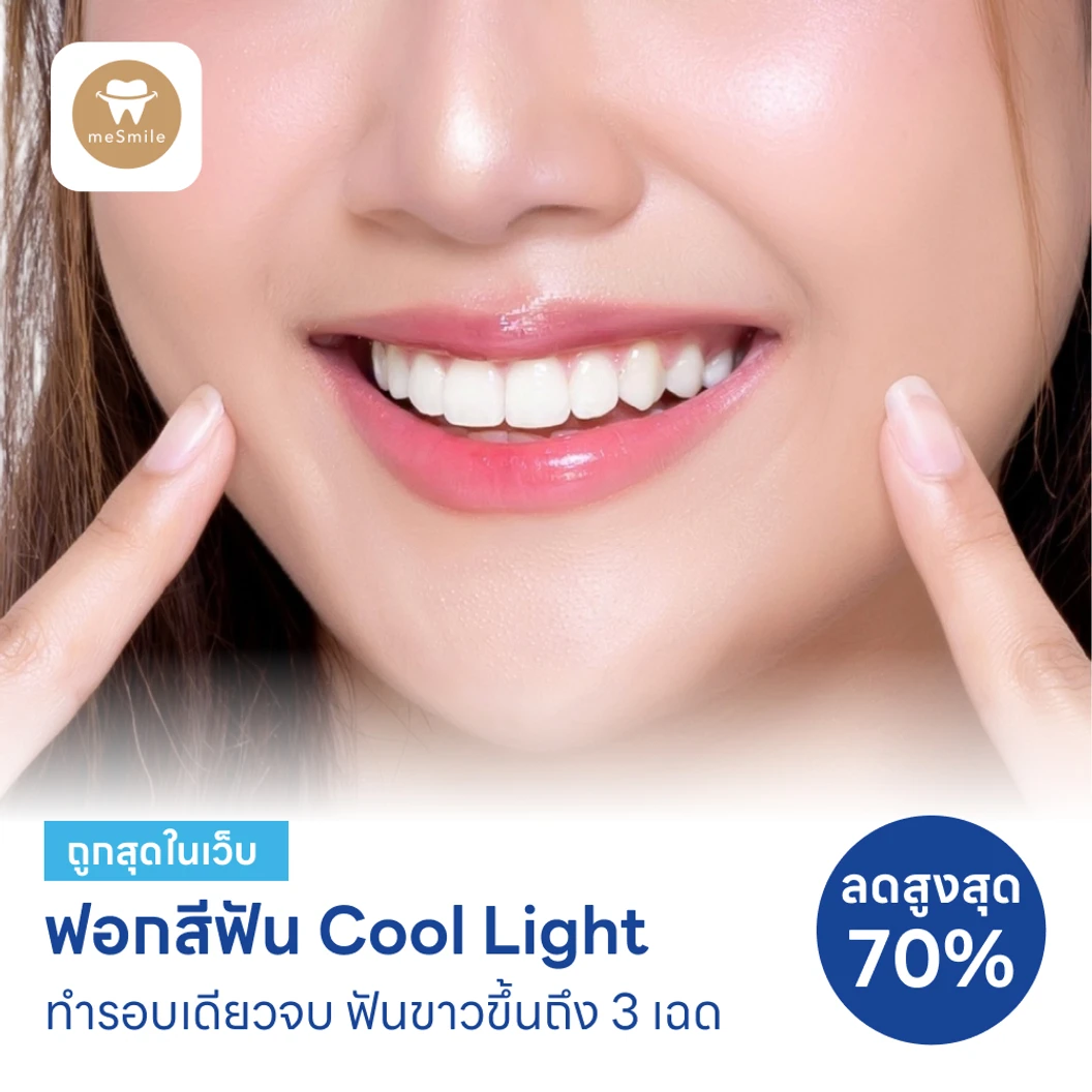 โปรแกรมฟอกสีฟันด้วยระบบ Cool Light พร้อมดูแลช่องปาก 4 รายการ แพ็กเกจ HDmall+ ที่ Mesmile Dental Clinic
