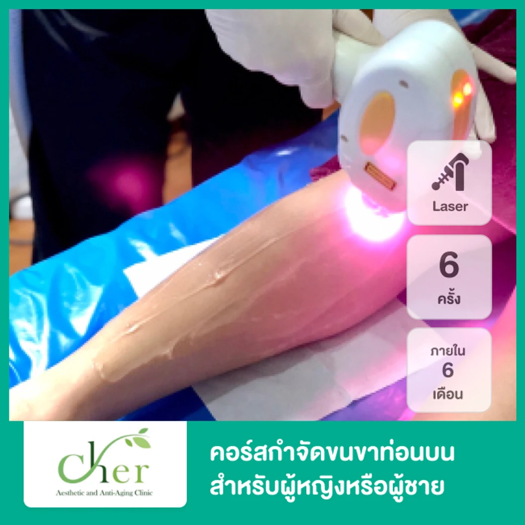 คอร์สกำจัดขนขาท่อนบน ด้วย Diode Laser 6 ครั้ง ภายใน 6 เดือน สำหรับผู้หญิงหรือผู้ชาย ที่ Cher Clinic