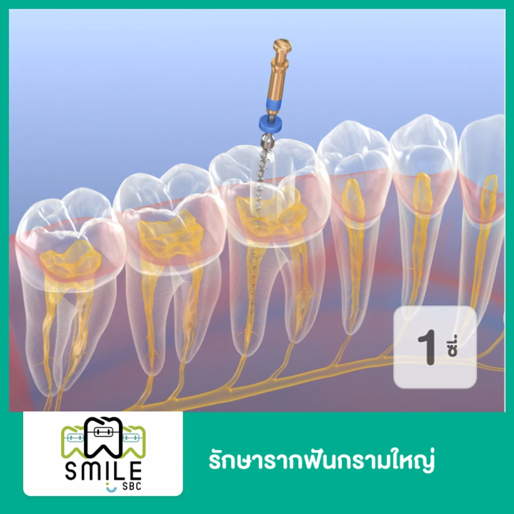 รักษารากฟัน กรามเล็ก หรือกรามใหญ่ 1 ซี่ ที่ SmileSBC