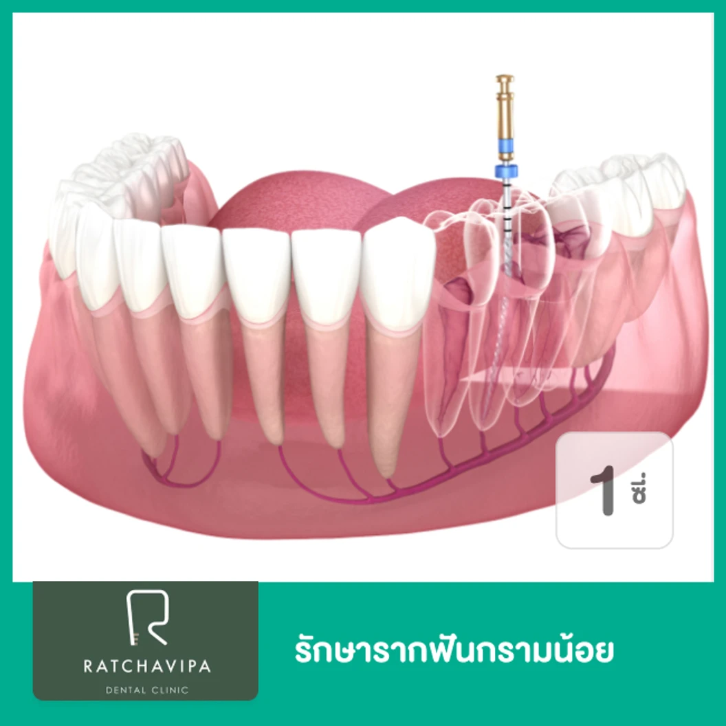 รักษารากฟันกรามน้อย 1 ซี่ ที่ Ratchavipa Dental Clinic คลินิกทันตกรรมรัชวิภา