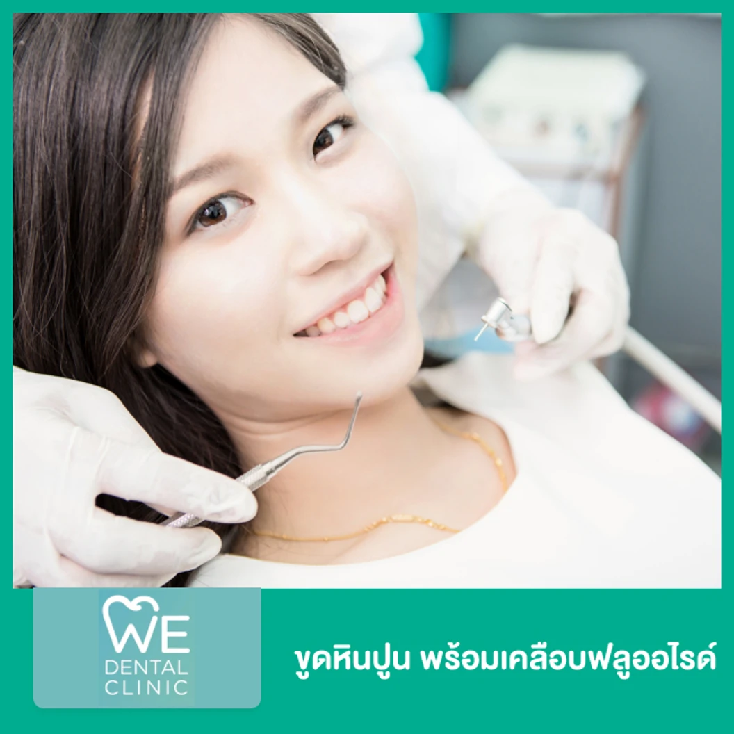 ขูดหินปูน พร้อมเคลือบฟลูออไรด์ ที่ WE Dental Clinic
