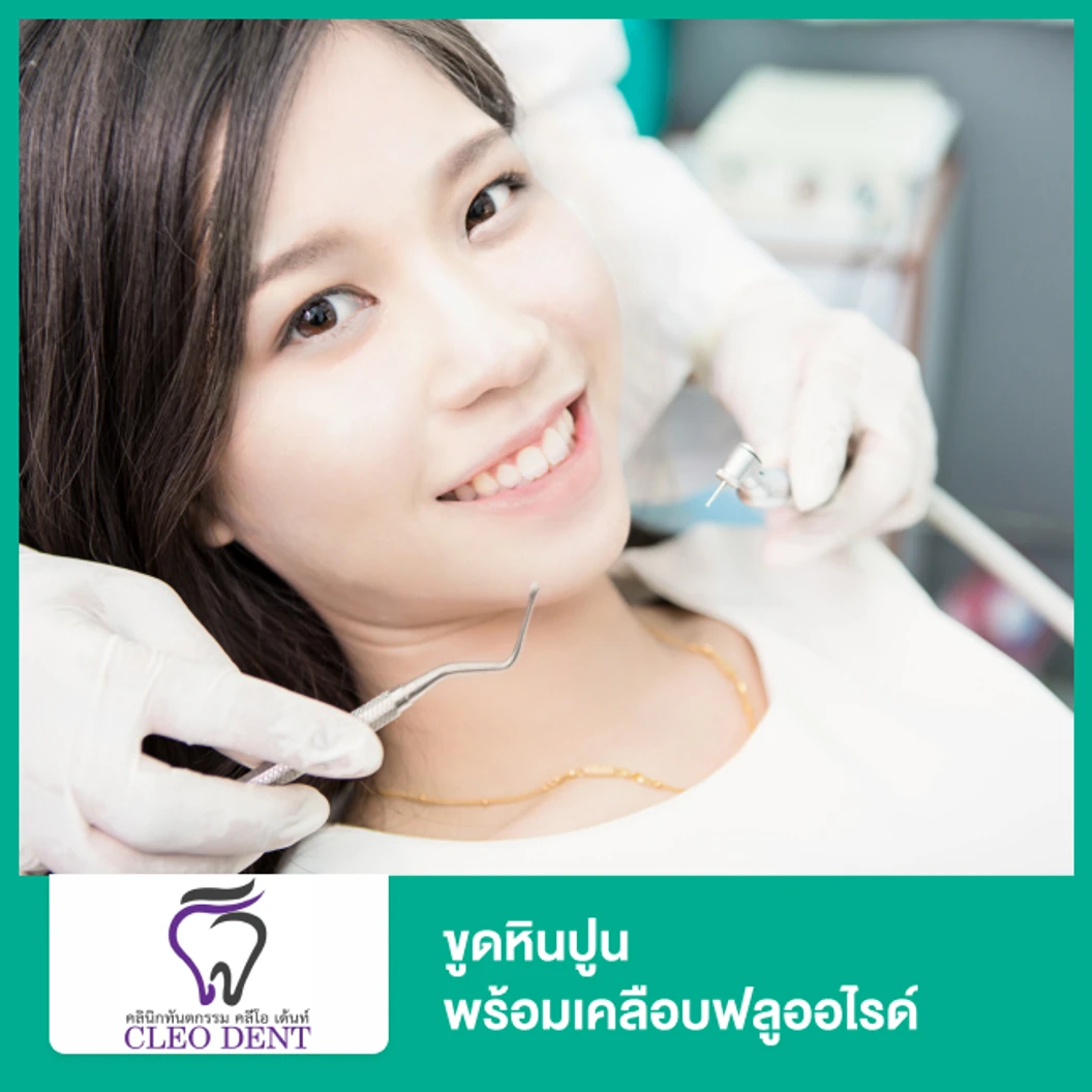 ขูดหินปูน พร้อมเคลือบฟลูออไรด์ ที่ Cleo Dent Dental Clinic