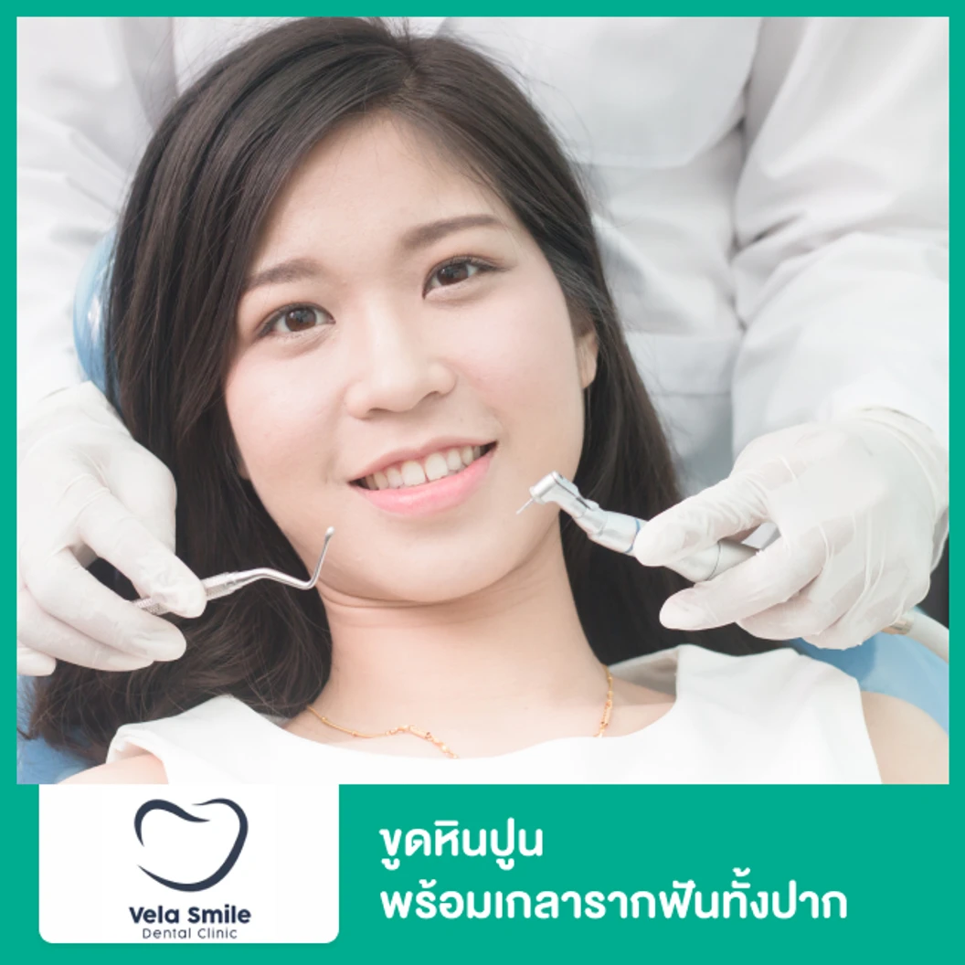 ขูดหินปูน พร้อมเกลารากฟันทั้งปาก ที่ Vela Smilee Dental Clinic