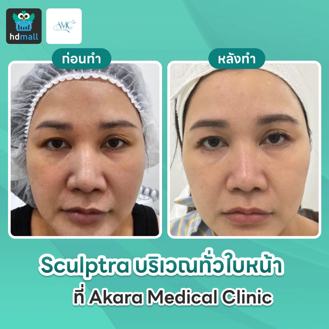 โปรแกรม Sculptra 10 ซีซี กระตุ้นการสร้างคอลลาเจน บริเวณทั่วใบหน้า 1 ครั้ง ที่ Akara Medical Clinic
