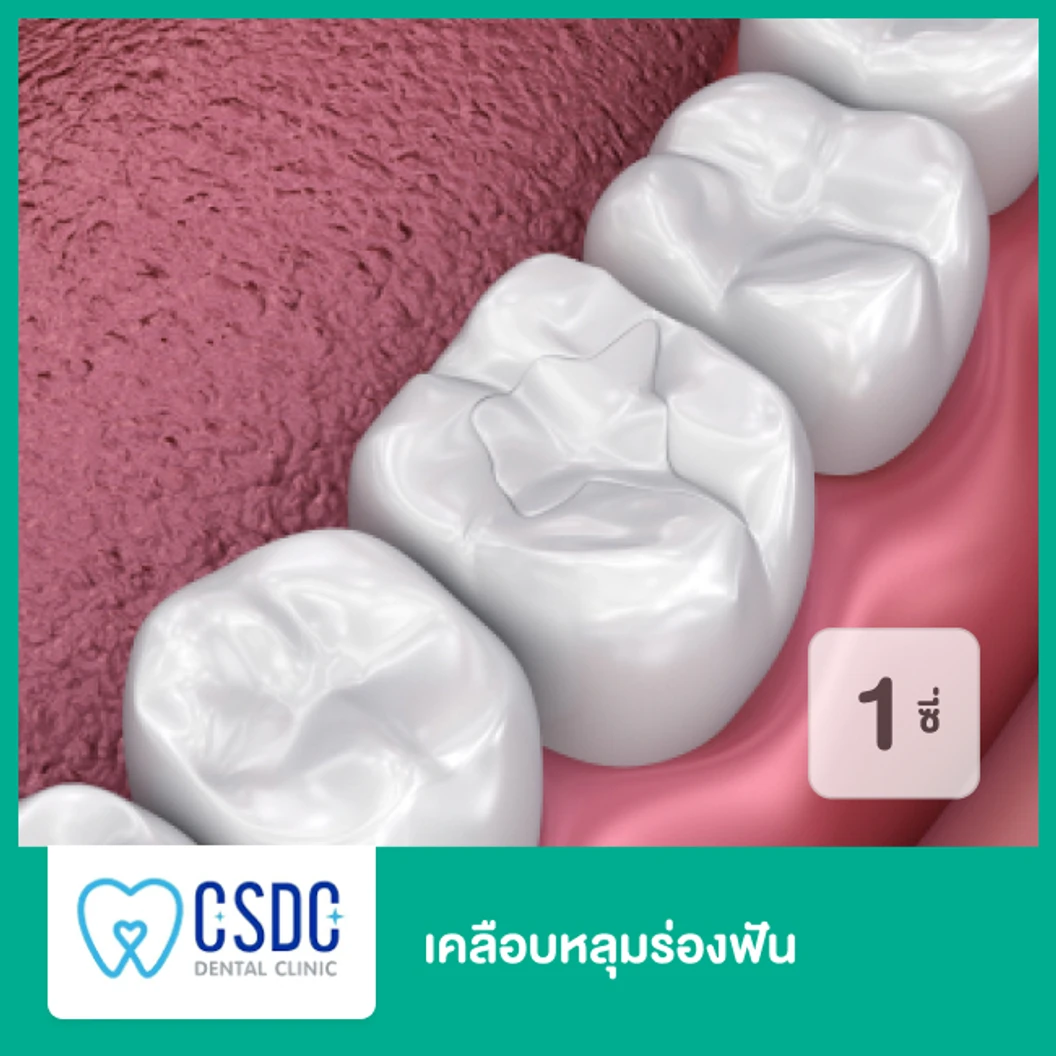 เคลือบหลุมร่องฟัน สำหรับฟัน 1 ซี่ เฉพาะสาขา ม.เกษตรเท่านั้น ที่ CSDC