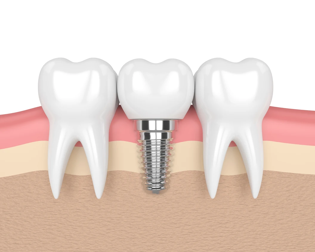 ทำรากฟันเทียม ยี่ห้อ Osstem รวมครอบฟัน 1 ซี่ ที่ We Smile Dental Clinic
