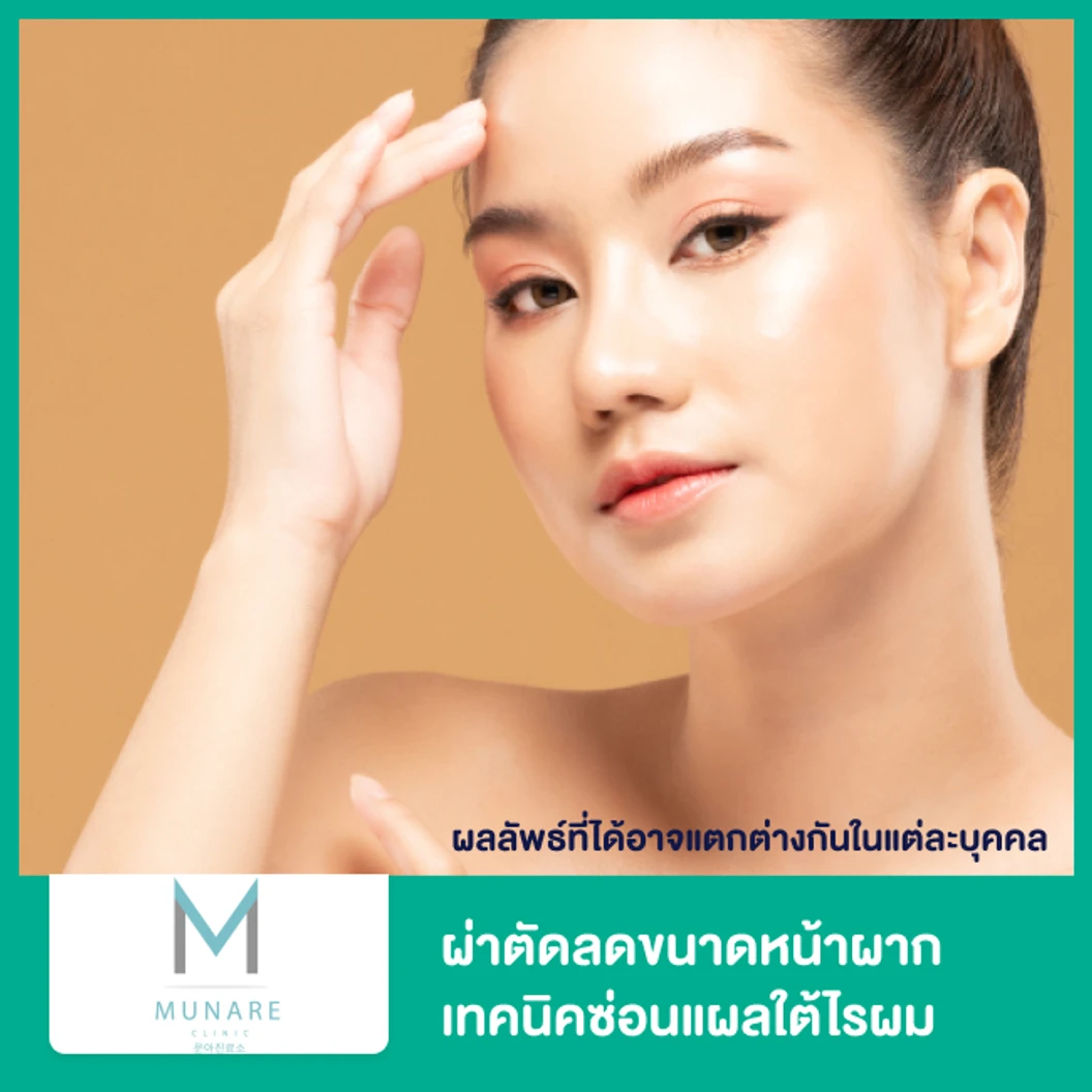 ผ่าตัดลดขนาดหน้าผาก เทคนิคซ่อนแผลใต้ไรผม ที่ Munare Clinic