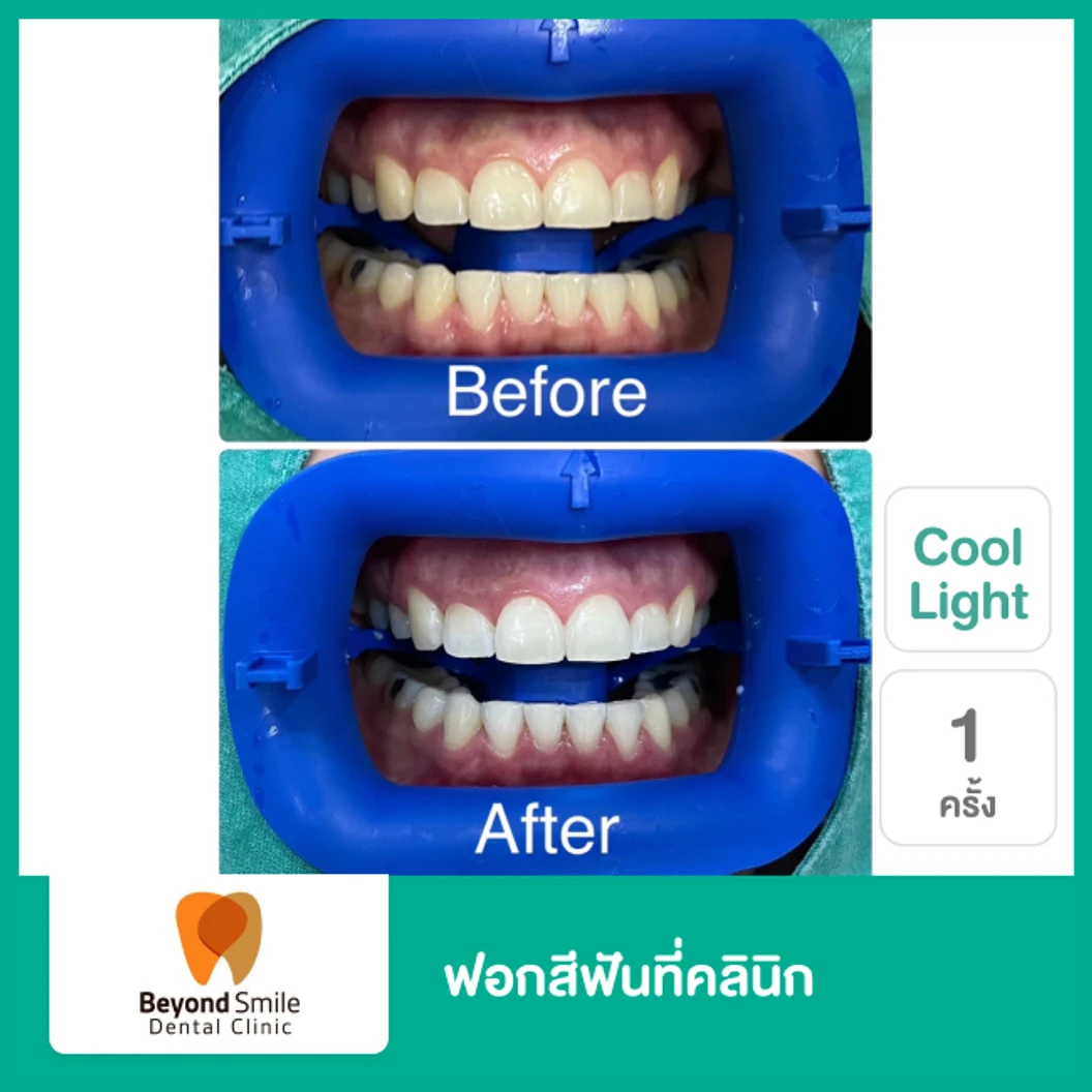 ฟอกสีฟันที่คลินิก ด้วยระบบ Cool Light 1 ครั้ง ที่ Beyond Smile Dental Clinic