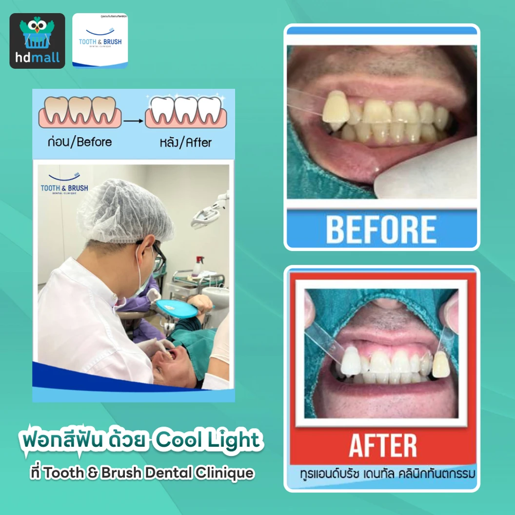 ฟอกสีฟัน ด้วยระบบ Cool Light ที่ Tooth & Brush Dental Clinique