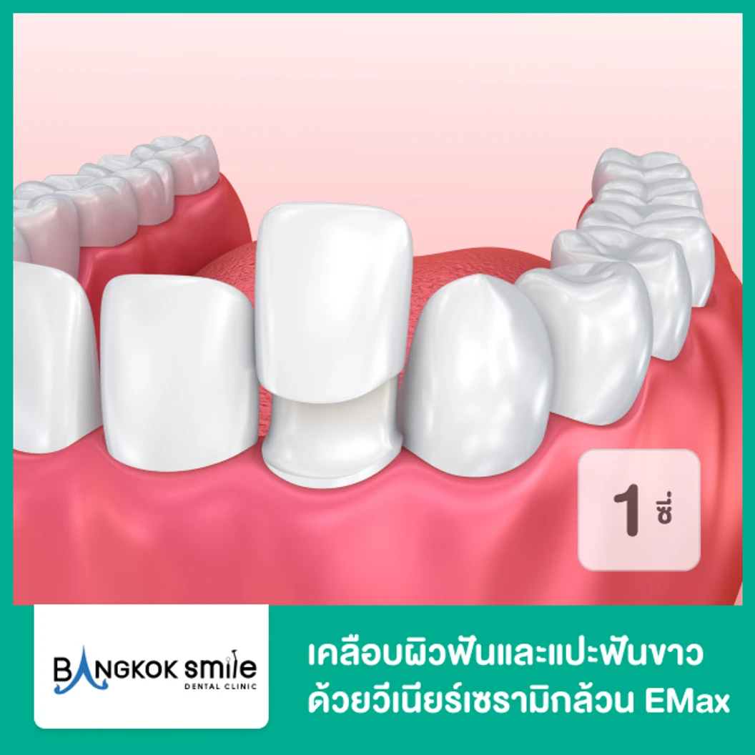 เคลือบผิวฟันและแปะฟันขาว ด้วยวีเนียร์เซรามิกล้วน EMax 1 ซี่ ที่ Bangkok Smile Dental