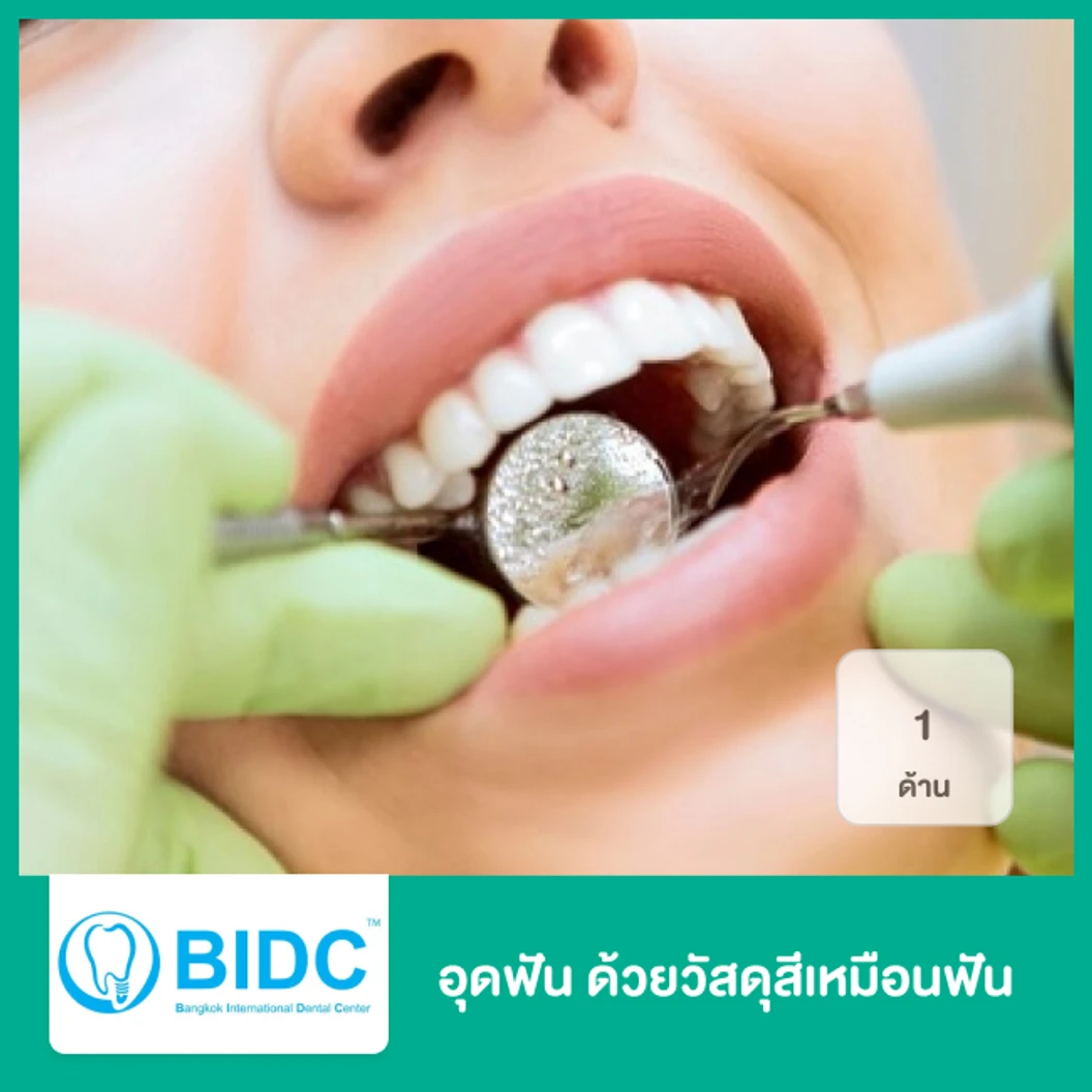อุดฟัน 1 ด้าน ด้วยวัสดุสีเหมือนฟัน ที่ BIDC Dental Center BIDC