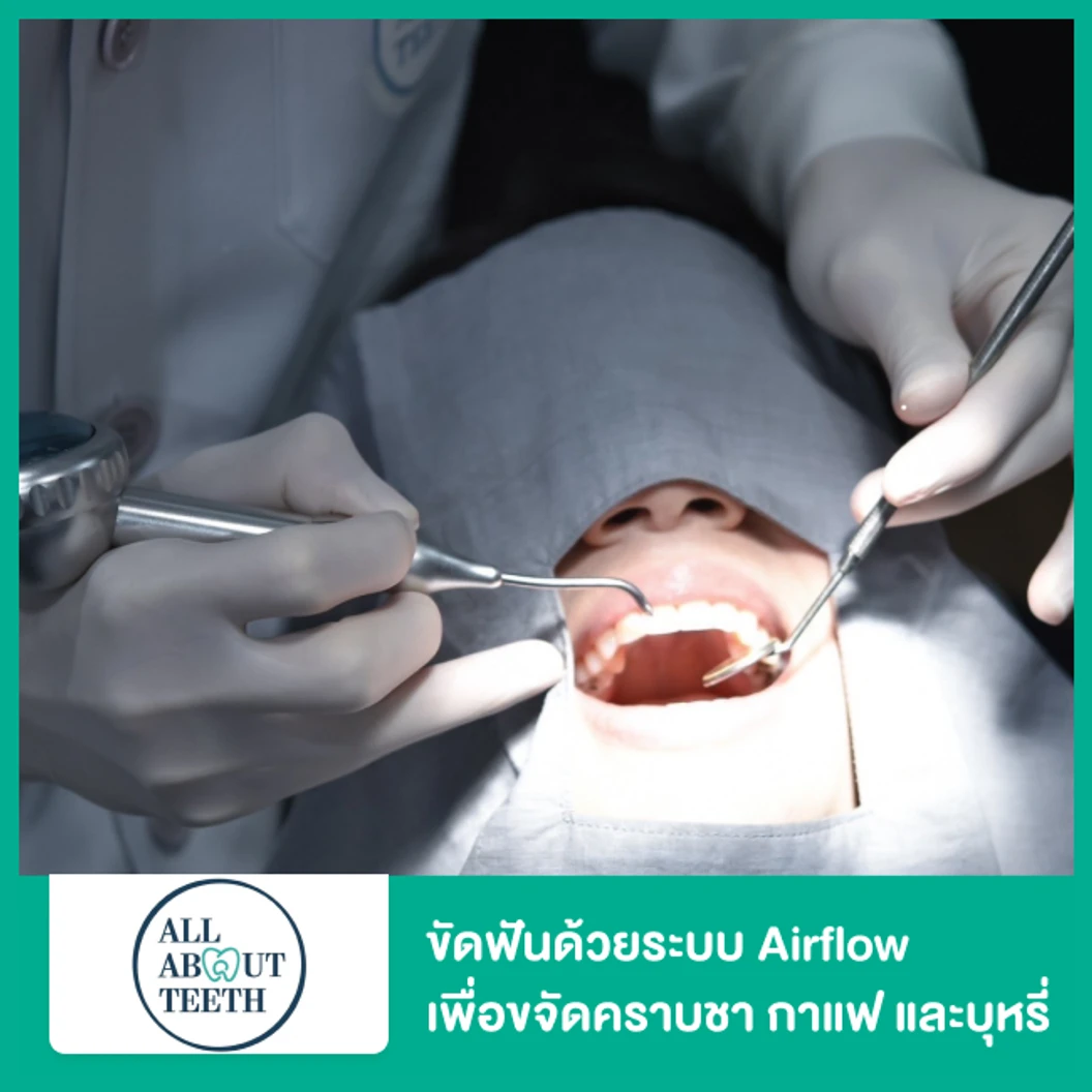 ขัดฟันด้วยระบบ Airflow เพื่อขจัดคราบชา กาแฟ และบุหรี่ ที่ All About Teeth Clinic